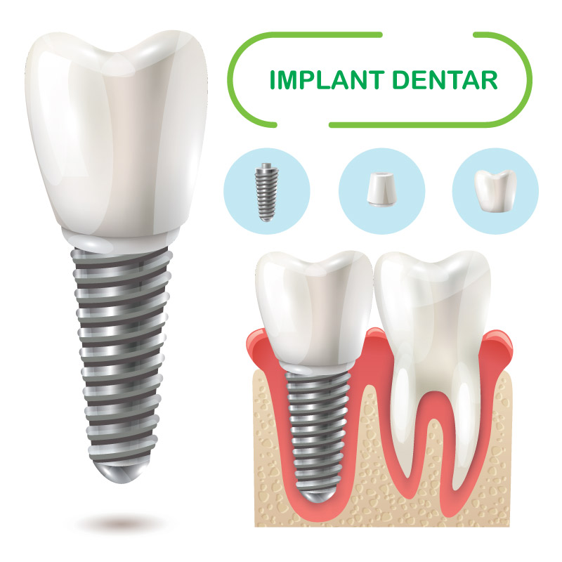 Implant dentar