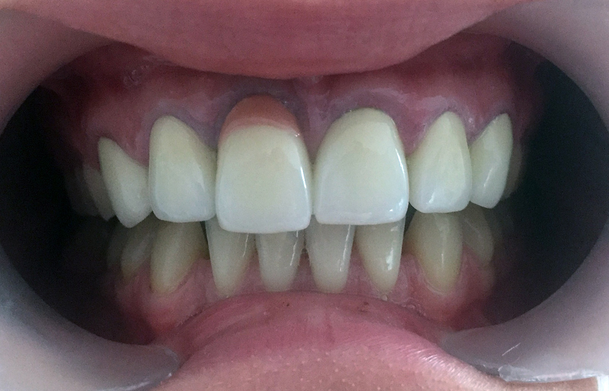 dispozitiv corono-radicular