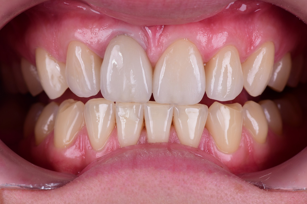 Coroane finale compozit